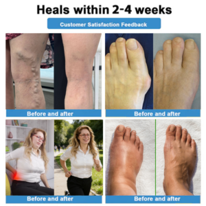 Healrize® 4-in-1 Vein & Joint Nano Microneedle Advanced Therapy Patch