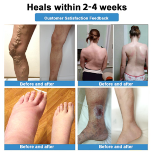 Healrize® 4-in-1 Vein & Joint Nano Microneedle Advanced Therapy Patch