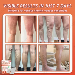 Zvoevo® Vein Ease Microneedle Care Patch