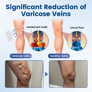 Timilk® Vein Ease Microneedle Therapy Patch
