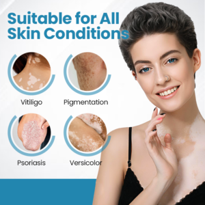 Acezozla® DermaBeam Vitiligo Therapy Device