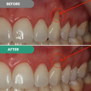 Cureend Teeth Repair Gel