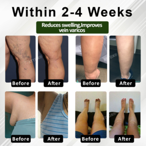 ATTDX® FluidEase Leg Therapy Edema Cream