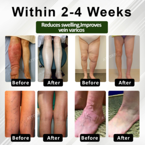 ATTDX® FluidEase Leg Therapy Edema Cream