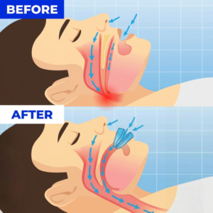 AirVex Pro Anti-Snoring Mouthpiece
