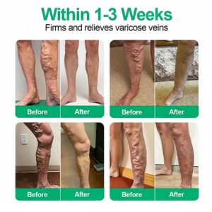 Healrize® VeinEase Microneedle Care Patch