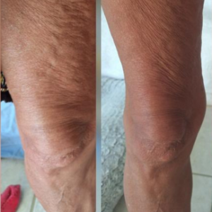 FemKora Anti-Cellulite Massage Oil