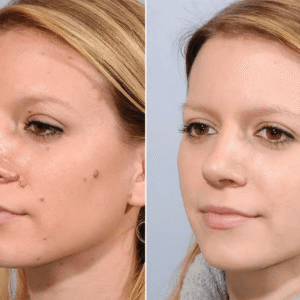 Celestvéra Wart Gone Cream Effective Removal