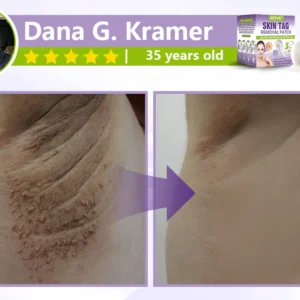 GFOUK® Soluble Microneedle Botanical Skin Tag Removal Patch