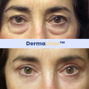 DermaLisse™ Lift Serum | Lift your face without botox in 1 week!