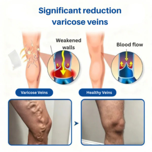 Venalix Microneedle Patch for Varicose Veins
