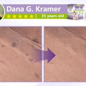 GFOUK® Soluble Microneedle Botanical Skin Tag Removal Patch