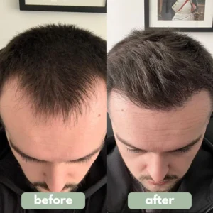 Reverse - Hair Growth Roll-On Serum