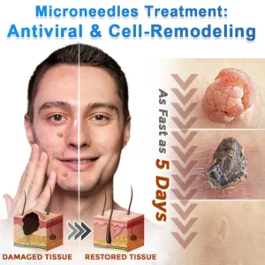 SkinPrkryn Microneedle Flawless Skin Tag Removal Patch