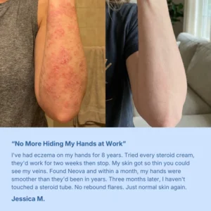 Neuvo Eczema & Psoriasis Cream