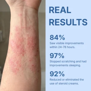 Neuvo Eczema & Psoriasis Cream
