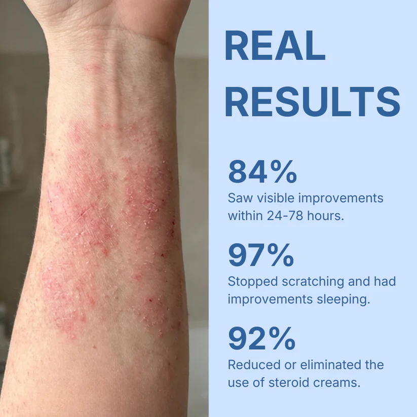 Neuvo Eczema & Psoriasis Cream